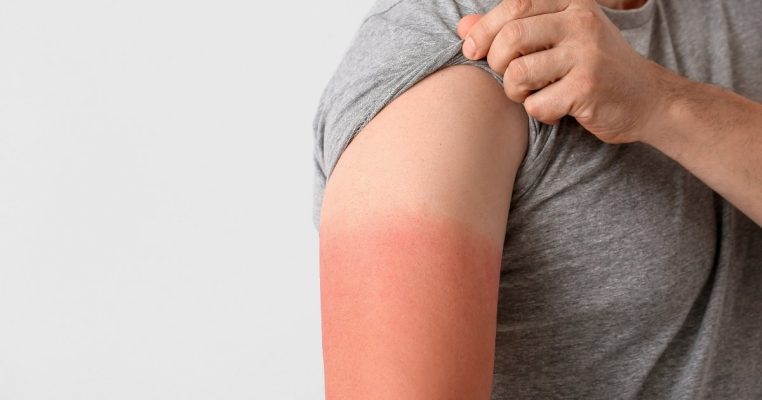 Cách trị làn da cháy nắng hiệu quả, trẻ hóa và làm đẹp sức khỏe