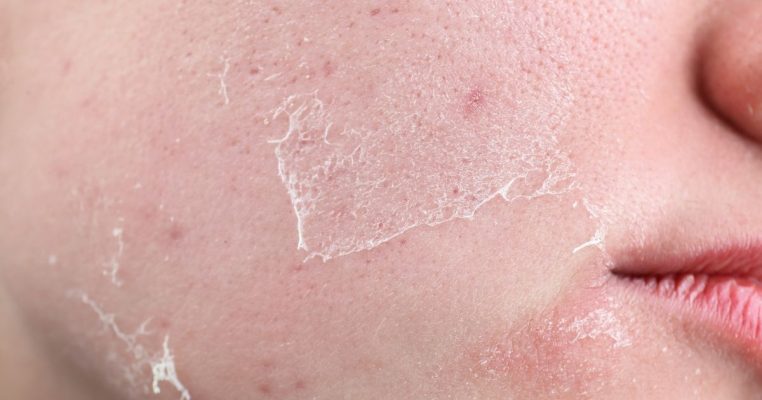 Chăm sóc da sau peel: Bí quyết trẻ hóa và nâng cao sức khỏe sắc đẹp