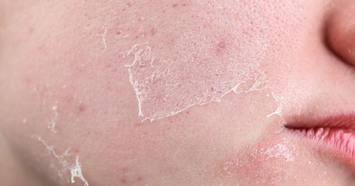 Chăm sóc da sau peel: Bí quyết trẻ hóa và nâng cao sức khỏe sắc đẹp