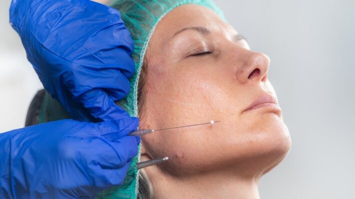 Căng Chỉ Collagen Có Đau Không