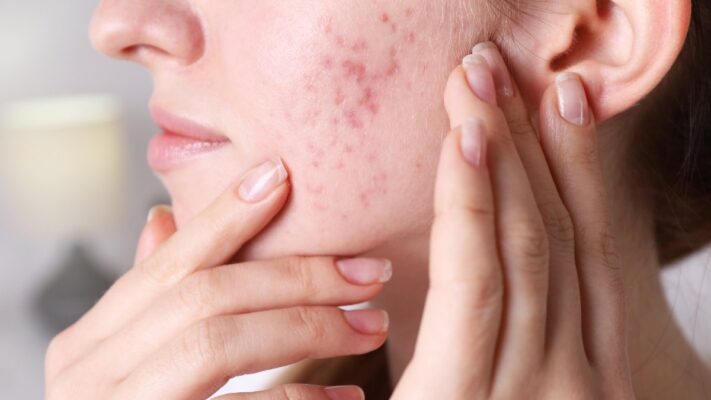 Sau peel da bị đẩy mụn phải làm sao