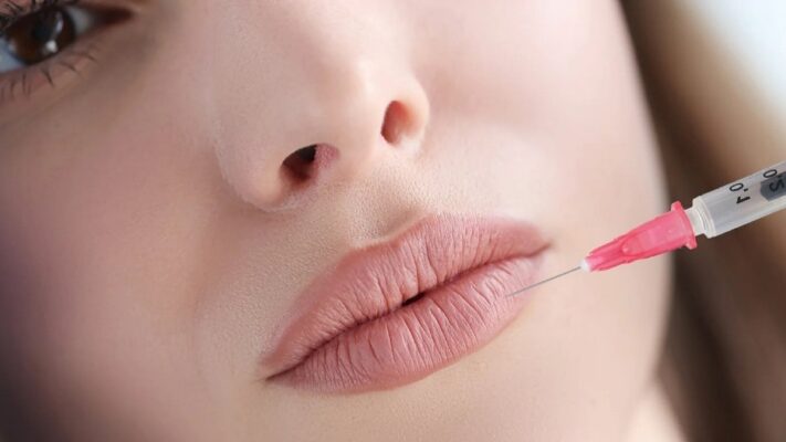 tiêm filler môi có hại về sau không