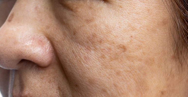 Tăng sắc tố da là gì