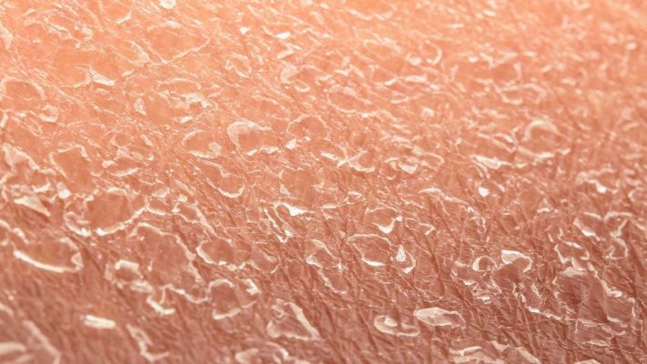 Mất nước là gì? Hiểu rõ tác hại khi tế bào mất nước